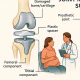 Joint Replacement Surgery: A Complete Guide to Hip and Knee Replacements